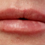 Lips Before & After Patient #9092