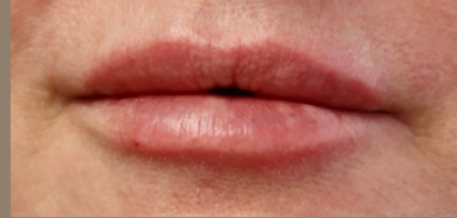 Lips Before & After Patient #9092