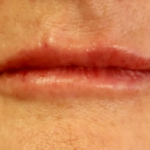 Lips Before & After Patient #9093