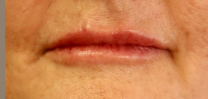 Lips Before & After Patient #9093