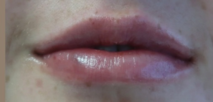 Lips Before & After Patient #9090