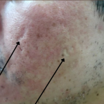 TCA Cross Before & After Patient #9204