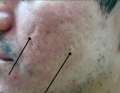 TCA Cross Before & After Patient #9204