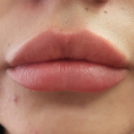 Bacio Lips Before & After Patient #9187