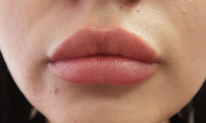 Bacio Lips Before & After Patient #9187