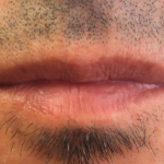 Bacio Lips Before & After Patient #9207