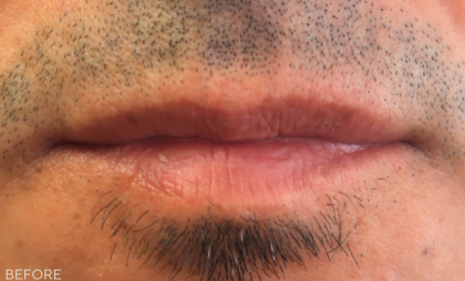 Bacio Lips Before & After Patient #9207