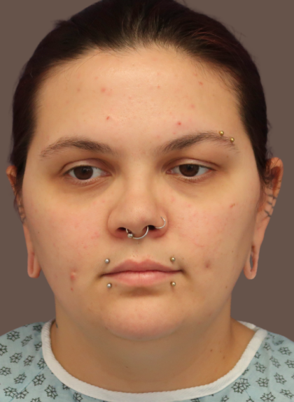 VASER Liposuction Before & After Patient #9210