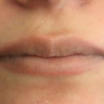 Bacio Lips Before & After Patient #9269