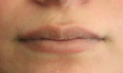 Bacio Lips Before & After Patient #9269
