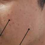 TCA Cross Before & After Patient #9204