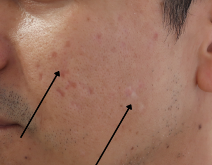 TCA Cross Before & After Patient #9204