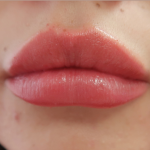Bacio Lips Before & After Patient #9187