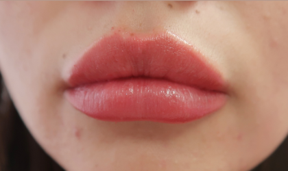 Bacio Lips Before & After Patient #9187