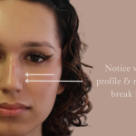 Non-Surgical Rhinoplasty Before & After Patient #9197