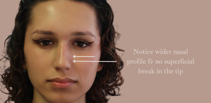 Non-Surgical Rhinoplasty Before & After Patient #9197