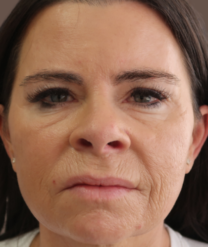 Microneedling with V Hacker Before & After Patient #9196