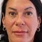 Sapphire Before & After Patient #9201