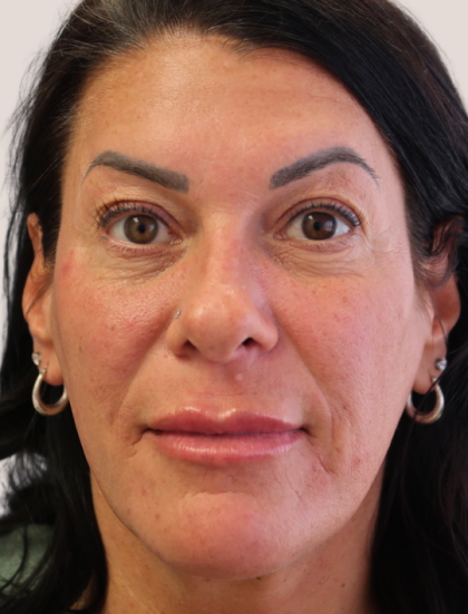 Sapphire Before & After Patient #9201