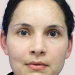 Sapphire Before & After Patient #9202
