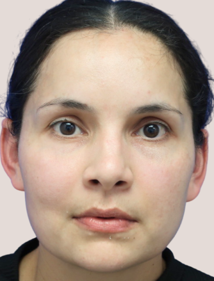 Sapphire Before & After Patient #9202