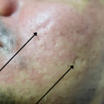 TCA Cross Before & After Patient #9205
