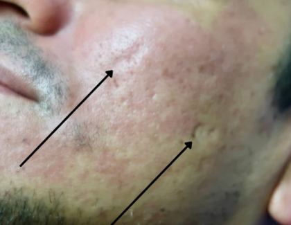 TCA Cross Before & After Patient #9205