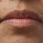 Bacio Lips Before & After Patient #9188