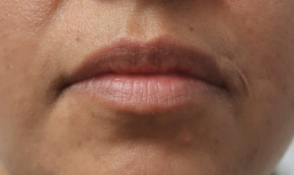 Bacio Lips Before & After Patient #9188
