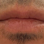 Bacio Lips Before & After Patient #9207