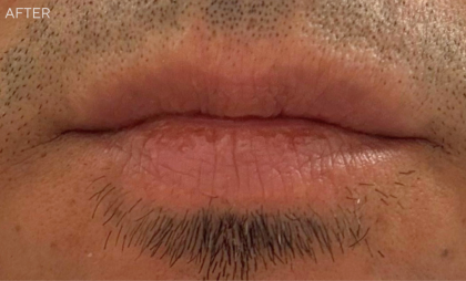 Bacio Lips Before & After Patient #9207