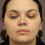 VASER Liposuction Before & After Patient #9210