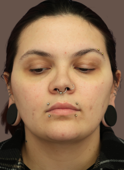VASER Liposuction Before & After Patient #9210