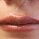 Bacio Lips Before & After Patient #9269