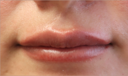 Bacio Lips Before & After Patient #9269