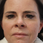 Microneedling with V Hacker Before & After Patient #9196