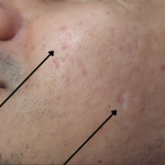 TCA Cross Before & After Patient #9205