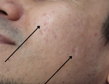 TCA Cross Before & After Patient #9205