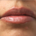 Bacio Lips Before & After Patient #9188