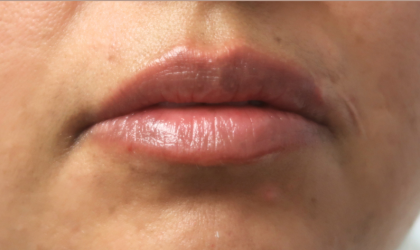 Bacio Lips Before & After Patient #9188