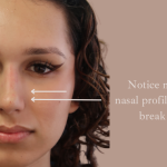 Non-Surgical Rhinoplasty Before & After Patient #9197