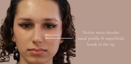 Non-Surgical Rhinoplasty Before & After Patient #9197