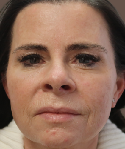 Microneedling with V Hacker Before & After Patient #9196