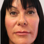 Sapphire Before & After Patient #9201