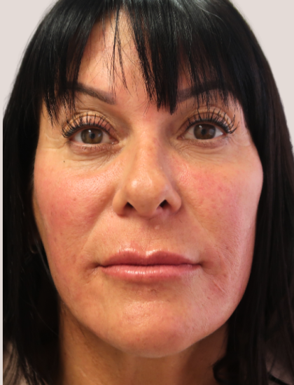 Sapphire Before & After Patient #9201