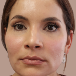 Sapphire Before & After Patient #9203