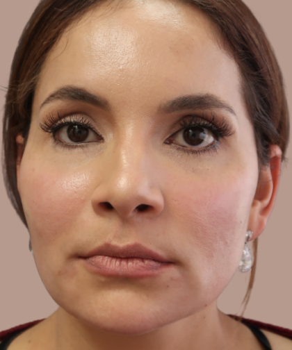 Sapphire Before & After Patient #9203