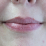 Bacio Lips Before & After Patient #9189
