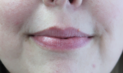 Bacio Lips Before & After Patient #9189