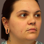 VASER Liposuction Before & After Patient #9210